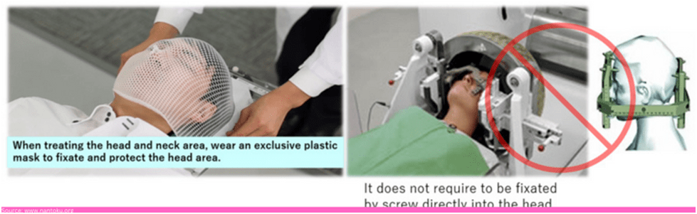 CyberKnife treatment 