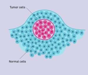 Malignant Tumors | Dr.Sridhar PS