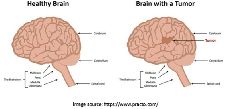 Overview of Brain Tumor | Dr. Sridhar PS