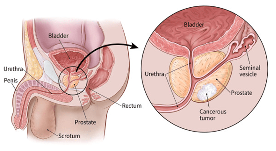 immunotherapy-for-prostate-cancer