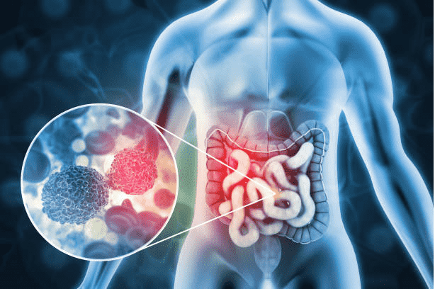 12-cycles-of-chemotherapy-for-colon-cancer