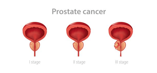 Prostrate Cancer