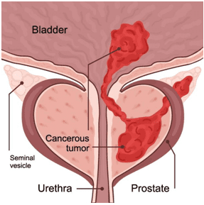 Stages of Prostrate Cancer