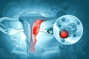 cervical cancer