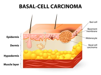 Basal Cell Carcinoma Untreated For 5 Years