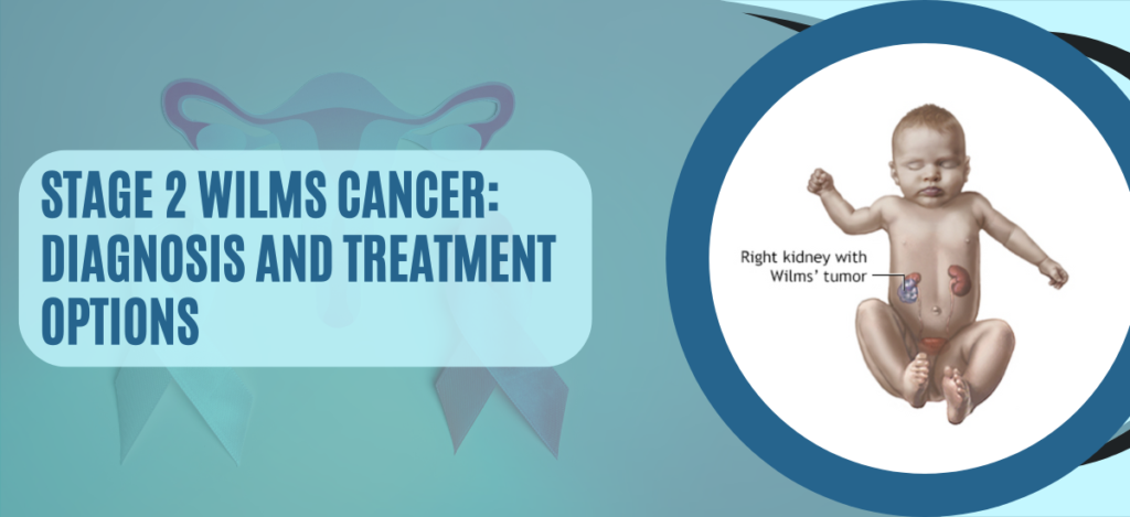 Stage 2 Wilms Cancer: Diagnosis and Treatment Options