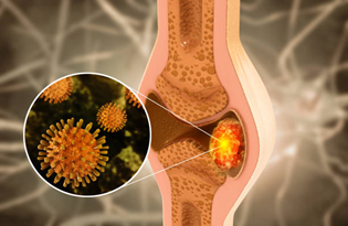 Bone Cancer Treatment