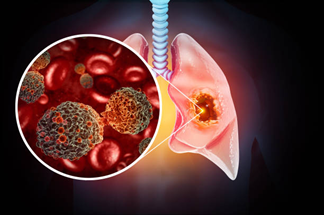 Lung Cancer Treatment