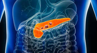 Pancreatic Cancer Treatment