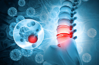 Spinal Cancer Treatment